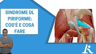 Sindrome del piriforme cosè e come si cura [upl. by Alejandrina]