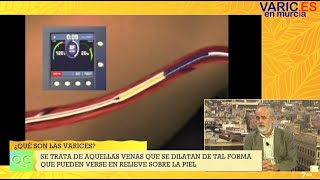 Entrevista sobre varices en La7Tv Murcia agosto2020 [upl. by Toft594]