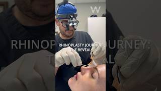 Rhinoplasty Patient Journey Part 4 Rhino Reveal Our patient sees her new nose for the first time [upl. by Imuy30]