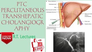 PTCPTHC PERCUTANEOUS TRANSHEPATIC CHOLANGIOGRAPHY Procedure HindiEnglish for BRT amp DRT students🥰 [upl. by Ytiak]