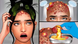 ASMR Head Acne Removal and Pimples Popping  Itchy Scalp Treatment ASMR [upl. by Aynwad]