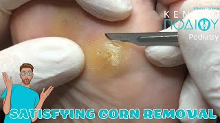 Corn Removal feet κεντροποδιου foot podologos podiatrist corn footcare podiatry callus [upl. by Jamin]