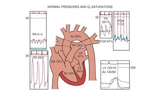 Right Heart Catheterization  an introduction [upl. by Richardo618]