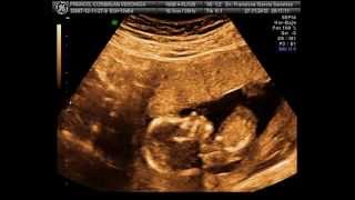 EMBARAZO 14 SEMANAS  ECOGRAFIA 3D y 4D de nuestro peke  ULTRASOUND 14 WEEKS SUANSI [upl. by Drewett]