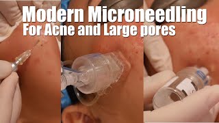 Acne scars and large pores treatment with microneedling and infusion of skin growth factors and stem [upl. by Farris]