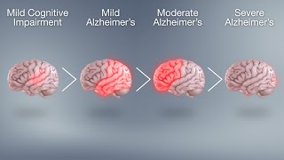 Alzheimers disease meaning  symptoms  treatment  causes [upl. by Ecyoj]