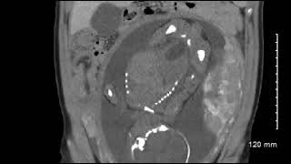 Pregnancy Intussusception CT Coronal JETem 2020 [upl. by Anayik]