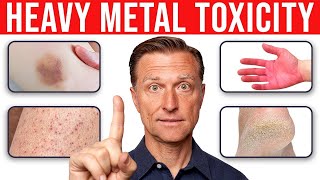 4 Skin Signs That Reveal Heavy Metal Toxicity [upl. by Demaria]