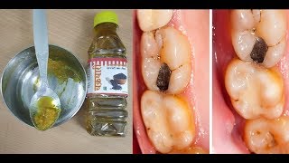 दांत का कीड़ा 2 मिनट में बहार निकाल देगा ये घरेलू नुस्खाhow To Get Rid Of Tooth Cavity [upl. by Knarf569]