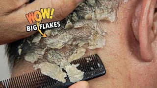 Itchy Psoriasis Scalp Scratching Big Flakes Satisfying 819 [upl. by Draillih665]