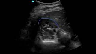 POCUS  Soft Tissue  Lymphadenopathy [upl. by Esinyl]