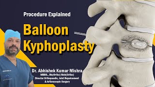 Balloon Kyphoplasty explained by Dr Abhishek Kumar Mishra [upl. by Genevra100]