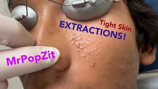 Tight skin acne extractions Comedonal acne with some inflammatory nodules Great session must see [upl. by Nnuahs]