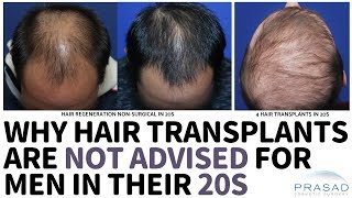 Why Hair Transplants are Not Advised for Men in their 20s [upl. by Nahtal]