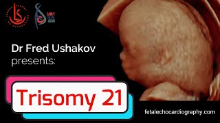 Down Syndrome Trisomy 21 – Medical Genetics  Lecturio [upl. by Einaoj]