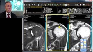 MRI Case Review Shoulder Deep Dive [upl. by Wernda]