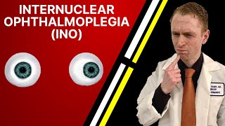 Neurologist Explains Internuclear Ophthalmoplegia INO [upl. by Halik]