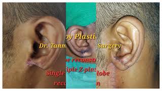 Plastic Surgery of Ear 1 cleftearlobe tumorofear earlobereconstruction ear keloid keloid [upl. by Edmund]