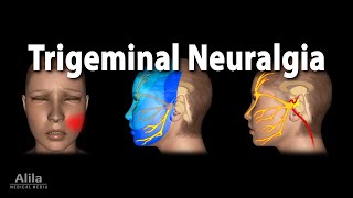 Trigeminal Neuralgia Tic Douloureux Animation [upl. by Jacqui]