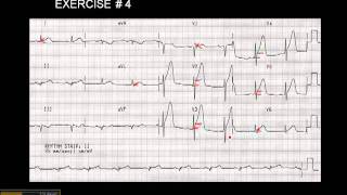 1215 Lead ECG Exercise  4 [upl. by Antony]