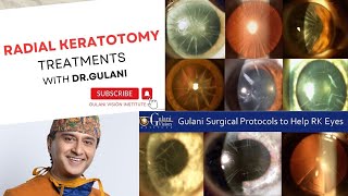 Radial Keratotomy Complications and Treatments  DrGulani explains his Mindset and Approach [upl. by Htebasil885]