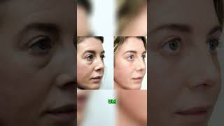 Blepharoplasty Recovery  Day 5 after surgery [upl. by Dnana]