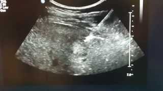 ULTRASOUNDGUIDED LIVER BIOPSY [upl. by Bronson649]