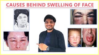 SWELLING FACE CAUSES  REASONS FOR SWOLLEN FACE  PUFFINESS OF FACE  RJDS MEDIX [upl. by Longerich]