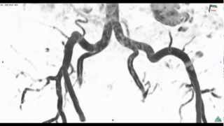 iliac artery MRI：腸骨動脈 [upl. by Ecitnirp]