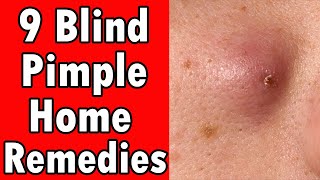 9 Home Remedies For A Blind Pimple [upl. by Mccormick701]