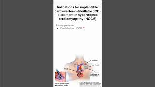 Indications for implantable cardioverterdefibrillator placement in hypertrophic cardiomyopathy [upl. by Aivatnwahs]