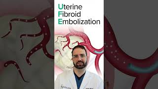 Uterine Fibroid Embolization UFE  North Star Vascular [upl. by Ten]