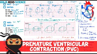 Rate and Rhythm  Premature Ventricular Contraction PVC [upl. by Hanoj96]