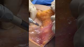 BLOODLESS TUMMY TUCK amp UMBILICAL HERNIA REPAIR BY DR GABRIEL PATINO 06 17 2024 5105257999 [upl. by Hillery]