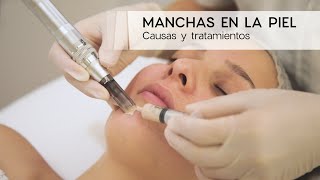 Manchas en la piel  Causas y tratamientos [upl. by Byrn]