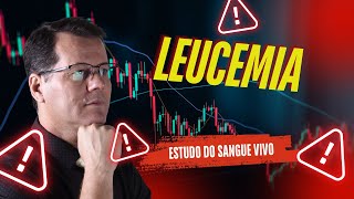 LEUCEMIA  Estudo do Sangue Vivo [upl. by Idnek]