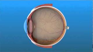 Vitrectomy Surgery for Detached Retina [upl. by Phio278]