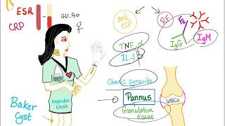 Rheumatoid Arthritis RA  Autoimmune Joint Disease  Pathophysiology  Rheumatology Playlist [upl. by Tristan]