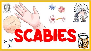 Scabies  Life Cycle Pathogenesis Types Signs amp Symptoms Risk Factors Diagnosis amp Treatment [upl. by Judenberg568]