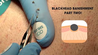 Blackhead Banishment Part Two Super Satisfying Blackhead Squeeze [upl. by Ratcliffe]