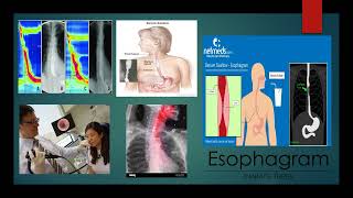 GabrielAvina 3MT Esophagram [upl. by Summers]