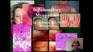 14 Inflammatory Myopathy Dermatomyositis Polymyositis Inclusion Body Myositis and others [upl. by Avehs]