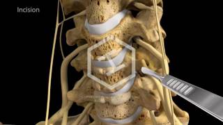 c5c6c7 Anterior Cervical Discectomy with Fusion [upl. by Him992]