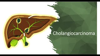 Cholangiocarcinoma [upl. by Aihsital]