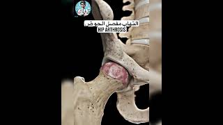 فيديو يوضح التهاب مفصل الحوض hiparthrosis hipreplacement arthritis nursingunlimitedvision [upl. by Down776]