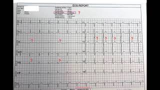 ECG et douleur épigastrique Quiz Dr Taboulet [upl. by Brien804]