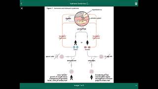 Kallmann Syndrome  متلازمة كولمان [upl. by Amaras]