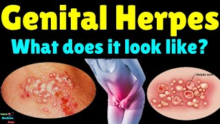 What Does Genital Herpes Look Like  Genital Herpes Signs and Symptoms Treatment and Complications [upl. by Mcgraw]