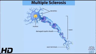 MULTIPLE SCLEROSIS Everything You Need To Know [upl. by Airdnna]