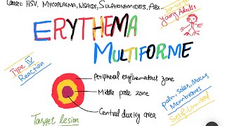 Erythema Multiforme EM causes symptoms treatment  skin disorder [upl. by Yeldarb]